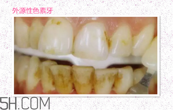 超聲波洗牙可以美白牙齒嗎？超聲波洗牙多少錢一次？