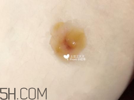 美寶濕潤燒傷膏怎么樣？美寶濕潤燒傷膏有用嗎？