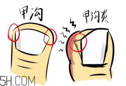 為什么容易得甲溝炎？怎么根治甲溝炎？