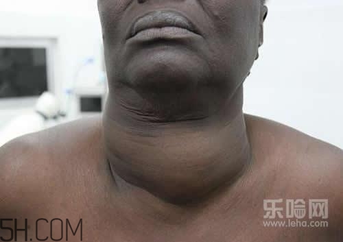 甲狀腺腫大和甲亢的區(qū)別有哪些？甲狀腺腫大適合吃什么食物？