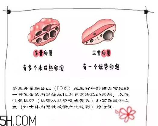多囊卵巢生不了？多囊卵巢懷孕要看準(zhǔn)時間