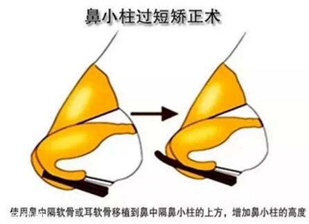 鼻小柱延長(zhǎng)用什么材料？?jī)?yōu)先選擇鼻中隔軟骨