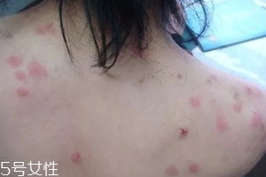 螨蟲(chóng)有哪些危害？嚴(yán)重時(shí)肌膚糜爛