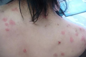 螨蟲有哪些危害？嚴(yán)重時肌膚糜爛