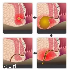 肛瘺非手術(shù)治療才可以嗎？手術(shù)是治療的關(guān)鍵途徑