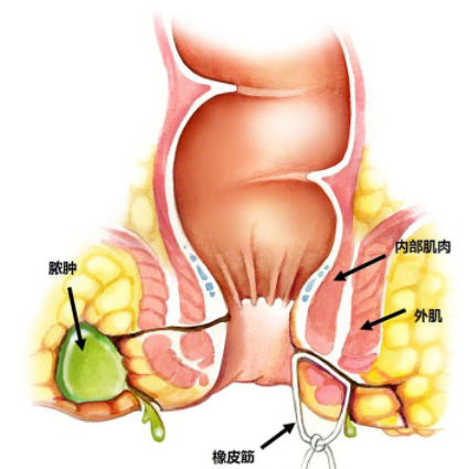 肛瘺非手術(shù)治療才可以嗎？手術(shù)是治療的關(guān)鍵途徑