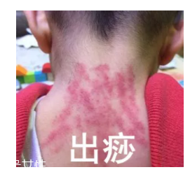 吮痧有什么療效？最溫柔的治病方法