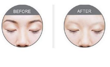 激光洗眉恢復(fù)期有疤痕怎么辦？激光洗眉毛之后正確護(hù)理方法