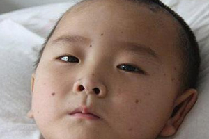 痣什么情況下會轉(zhuǎn)變?yōu)榱?？點痣不可取