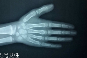 哪些人需要測骨齡？長太快警惕骨齡提前