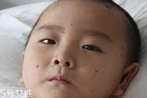 痣什么情況下會(huì)轉(zhuǎn)變?yōu)榱?？點(diǎn)痣不可取