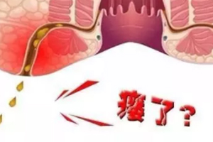肛瘺非手術治療才可以嗎？手術是治療的關鍵途徑