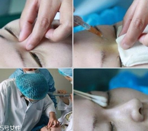 玻尿酸隆鼻維持時間受什么影響？玻尿酸不能過度注射