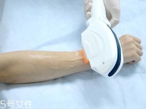 激光脫毛需要幾次？激光脫毛并不是終身有效的