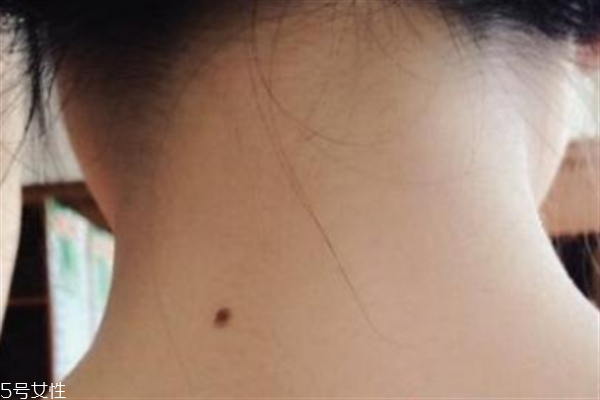 脖子后面有痣好嗎？激光冷凍祛痣易導(dǎo)致癌變