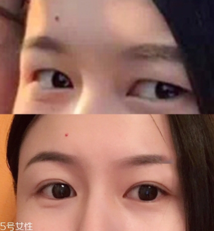 內(nèi)雙怎么進(jìn)化成雙眼皮？全是雙眼皮貼的功勞