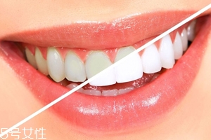 牙齒發(fā)黃是天生的嗎？只是你刷牙偷懶了