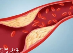 血管堵塞怎么自查？腿腳告訴你答案