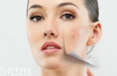 痘印多久能自行消失？多數(shù)人一年內(nèi)消失