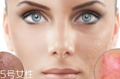 痘印多久能自行消失？多數(shù)人一年內(nèi)消失