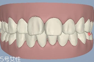 磨牙有哪些癥狀？牙齒變形甚至脫落