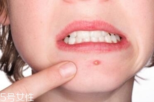 肌膚需要排毒嗎？長痘并不代表排毒