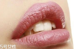 冬天爛嘴角什么原因？有可能營養(yǎng)不良