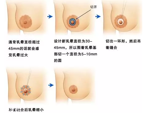 乳暈縮小術(shù)怎么做？乳暈縮小術(shù)知識(shí)全解