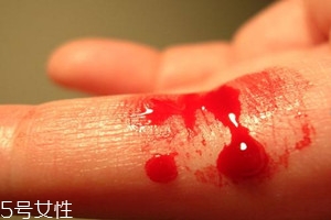 血友病的主要表現(xiàn)有哪些？出血是最明顯的特征