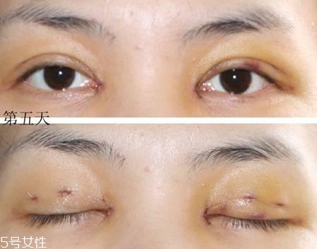 怎么縮短開眼角疤痕消失時(shí)間？雙眼皮開眼角恢復(fù)過程