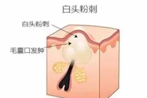 閉口是怎么引起的？4種情況要注意