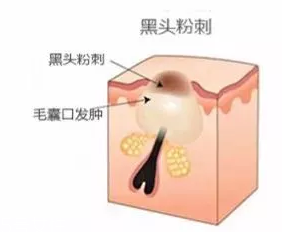 閉口是怎么引起的？4種情況要注意