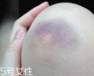 身體淤青怎么來的？不是磕碰那么簡(jiǎn)單