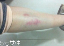 身體淤青怎么來的？不是磕碰那么簡(jiǎn)單