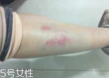 摔傷了涂什么藥好的快？做好消毒才能愈合快
