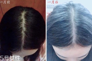 柳屋生發(fā)水有用嗎？一個(gè)月后長(zhǎng)出新發(fā)