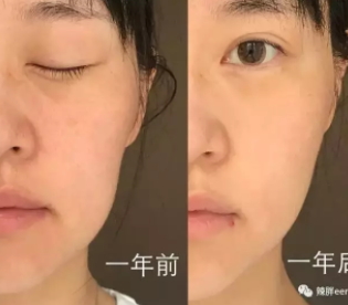 童顏機有用嗎？童顏機的功效