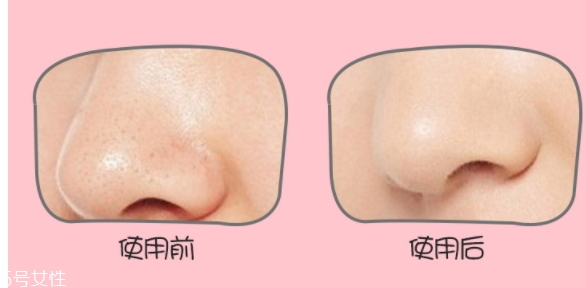 yoii黑頭儀怎么用？yoii黑頭儀怎么充電