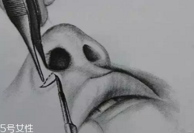 鼻翼外切多久消腫？鼻翼外切消腫時間要多長？
