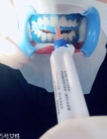 冷光美白會(huì)反彈嗎？冷光美白心得