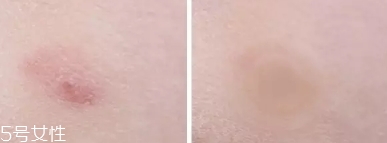 vt痘痘貼怎么用？vt老虎痘痘貼防水嗎