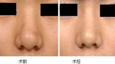 縮鼻手術多久恢復？縮鼻手術傷口才會好