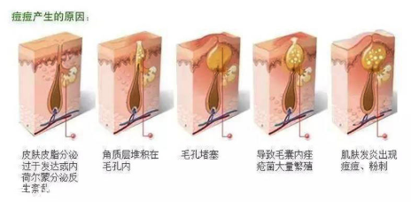 頑固痘痘怎么消除？油皮為什么反復(fù)爆痘？