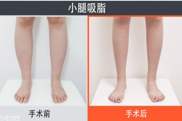 小腿吸脂后遺癥你知道多少？