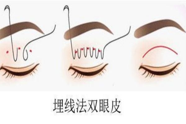 埋線(xiàn)雙眼皮感染怎么辦？埋線(xiàn)雙眼皮發(fā)炎了怎么辦