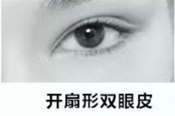 雙眼皮失敗修復手術(shù)好嗎 雙眼皮失敗修復