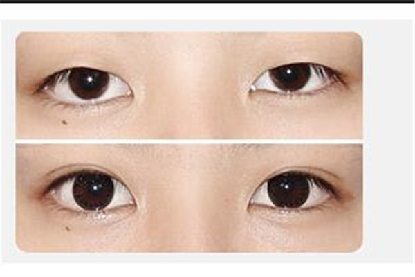雙眼皮失敗修復手術(shù)好嗎 雙眼皮失敗修復