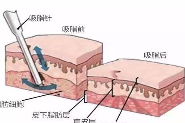 水動(dòng)力吸脂的工作原理是什么呢 水動(dòng)力吸脂多少錢(qián)一次呢