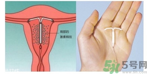 上環(huán)是什么意思？上環(huán)后注意事項(xiàng)有哪些？