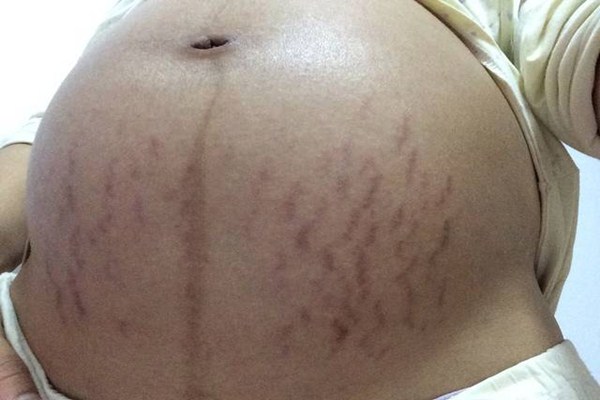 妊娠紋會(huì)長在脖子上嗎 為什么會(huì)形成妊娠紋